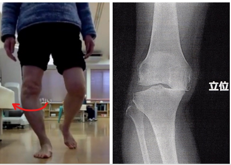 膝の痛み①　-痛みの原因は…？軟骨の擦り減り？-