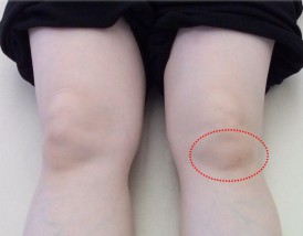 膝の痛み③　-膝蓋下脂肪体（しつがいかしぼうたい）-