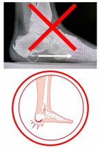 足底・踵の痛み　ー『踵骨棘』足底筋膜が引っ張るという誤りー